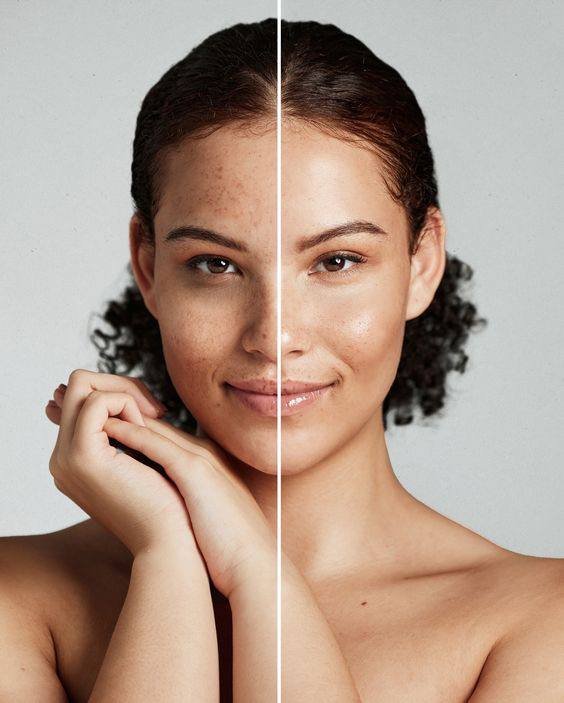 علاج التصبغات والبقع